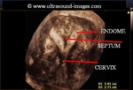 septate-uterus-3D