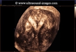 septate-uterus-3D