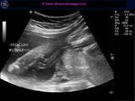 subseptate-uterus-pregnancy