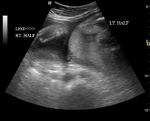 subseptate-uterus-pregnancy