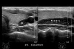 parathyroid-adenoma-huge