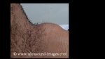 thyroglossal-duct-cyst-snap