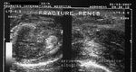 penile-fracture