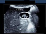 3-D ultrasound imaging of gall bladder calculi