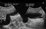 Calculus in Hartmann's pouch of gall bladder