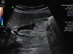 Gall bladder sludge simulating gall bladder neoplasm or mass
