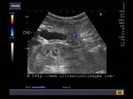 Color Doppler image shows feeder vessel in cholangiocarcinoma mass