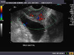Color doppler imaging of prostatitis