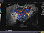 Ultrasound and Color Doppler imaging