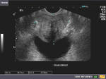 Large cyst of seminal vesicle