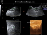 3D Ultrasound image of prostate calculus