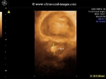 3D ultrasound images of large prostate calculus