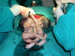 Snapshot of the conjoined twins after delivery