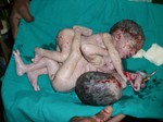 Snapshot of the conjoined twins after delivery