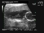 velamentous cord placenta