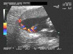 color Doppler velamentous cord placenta