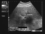 Diffuse fatty liver with focal fatty sparing
