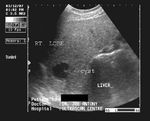 Liver cyst