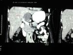 CT images of the same mass