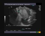 Transrectal Ultrasound image - calculi in bladder