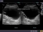 Urinary bladder wall trabeculation in a case of Lower urinary tract obstruction