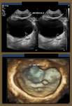 Ureterocele - 3D ultrasound image