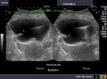 Orthotopic neobladder or neobladder to urethra diversion