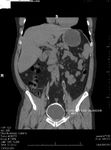 CT Scan imaging in Bilharziasis