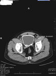 CT Scan imaging in Bilharziasis