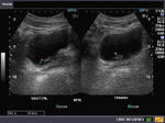 Ultrasound images of polyp (inverted papilloma) in urinary bladder