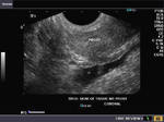 Ultrasound images of polyp (inverted papilloma) in urinary bladder