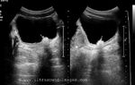 Endoscopic Teflon or Deflux gel treatment for Vesico-ureteral reflux