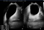 Ultrasound images of urinary bladder herniation into the right scrotum