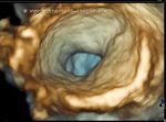 3D ultrasound image: Bladder hernia