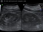 Carcinoma urinary bladder- 3D ultrasound images