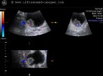 Carcinoma urinary bladder- 3D ultrasound images