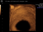normal urinary bladder-3d ultrasound