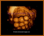 3D ultrasound- multiple bladder calculi