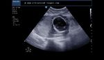 Severe oligohydramnios in late 2nd trimester