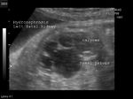 Fetal hydronephrosis