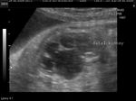 Fetal hydronephrosis