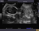 Fetal polycystic kidneys