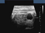 Fetal simple renal cyst
