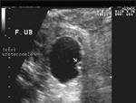 Fetal ureterocele