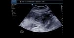 Fetal bilateral multicystic kidney disease