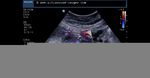 Fetal bilateral multicystic kidney disease