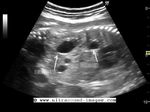 Fetal cross fused ectopia