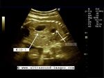 Fetal cross fused ectopia
