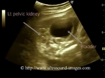 fetal-pelvic-kidney