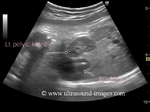 fetal-pelvic-kidney
